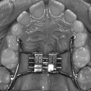 Rapid maxillary expansion in therapy-resistant enuretic children: