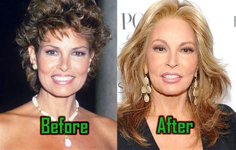 Did Raquel Welch get a nose job? Does Raquel Welch have fake boobs? All plastic surgery info, including facelift, nose job, body measurements, botox, and lips, is listed below! Biography/Wiki. Despite of what many her fans would like to see, Raquel never posed completely topless.. 