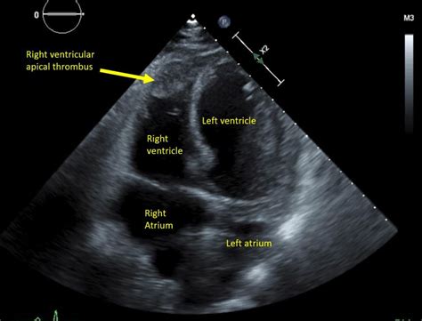 Rarecase of biventricular thrombi complicating pulmonary …