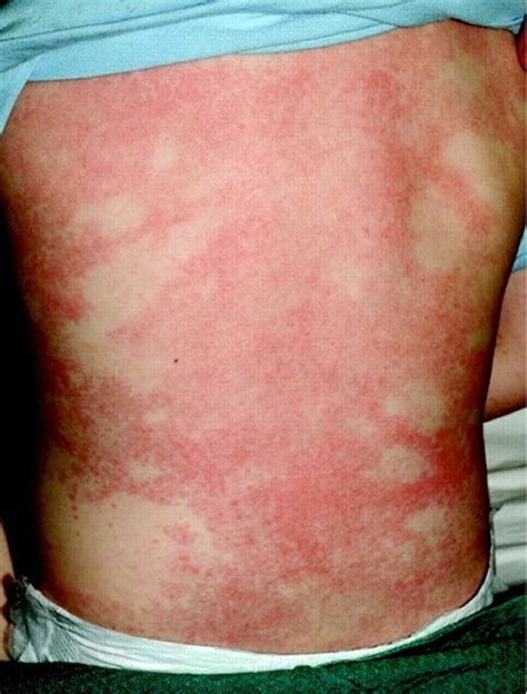 Rash after fever adults HealthTap Online Doctor