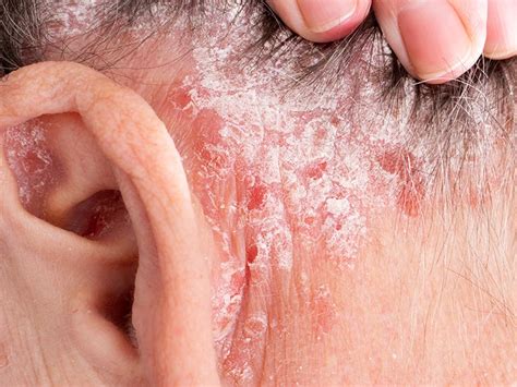 Rash behind ear: Causes, other symptoms, and …