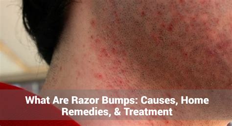 Razor Bumps: Causes, Symptoms, Treatment