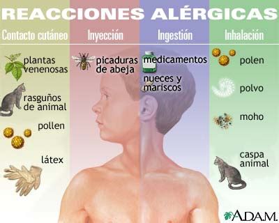 Reacciones alérgicas: MedlinePlus enciclopedia médica