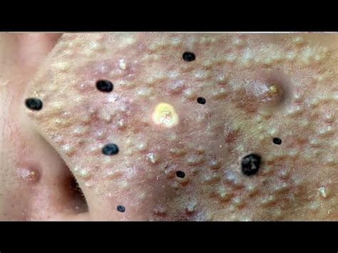 Reacting to Ear Clear from Deep Blackhead in Pore #shorts