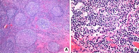 Reactive Tonsillar Enlargement Showing Strong 18F-Fdg Uptake …