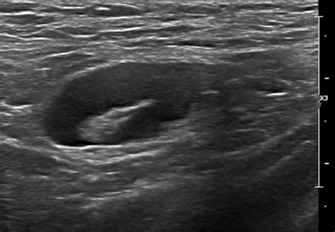 Reactive Unilateral Axillary Adenopathy Following COVID-19 …