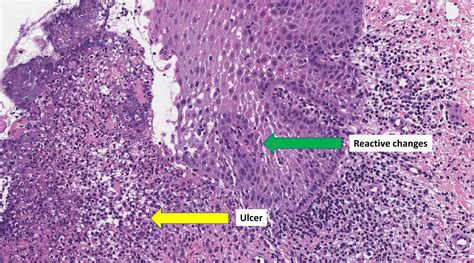 Reactive changes - Libre Pathology