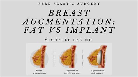 Really young flat chested breasts.  However, this can be corrected with breast augme...