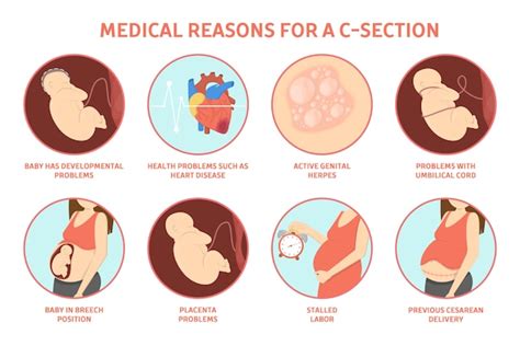 Reasons for a C-Section: Medical and Elective