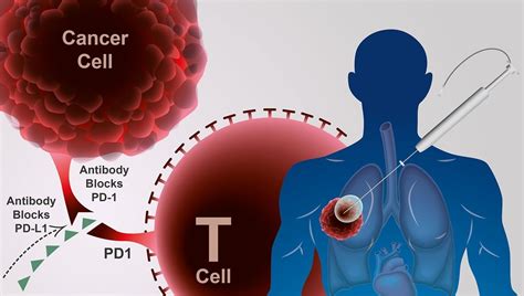 Recent cancer treatment. Things To Know About Recent cancer treatment. 