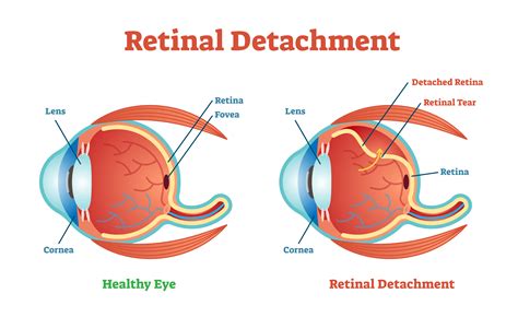 Recently, I have reason to believe i have Retinal detachment