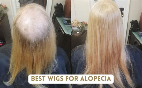 Reclaiming Confidence and Comfort with Wigs for Alopecia Patients