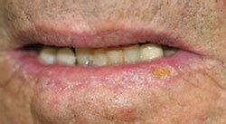 Recognition and Treatment of Actinic Cheilitis AAFP