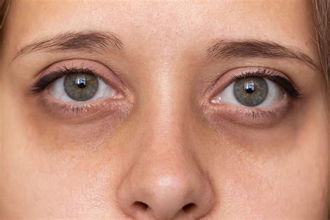 Recovering from Lower Blepharoplasty What You Need to Know