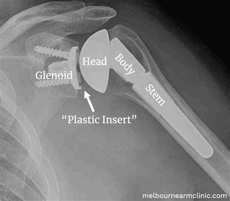 Recovery Time for Reverse Shoulder Replacement Surgery