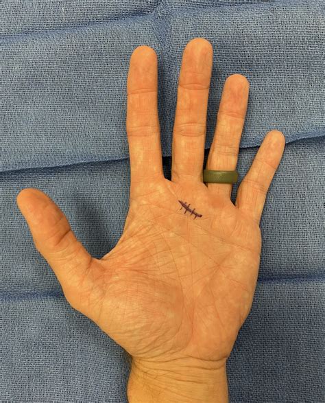 Recovery from Trigger Finger Surgery What to Expect