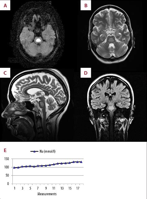 Recovery of locked-in syndrome in central pontine myelinolysis