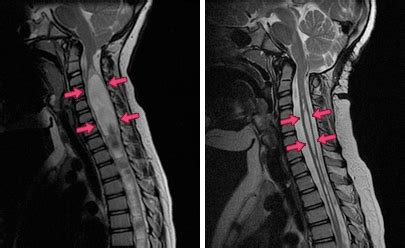 Recovery time after removal of syrinx? (no chiari) - Chiari ...