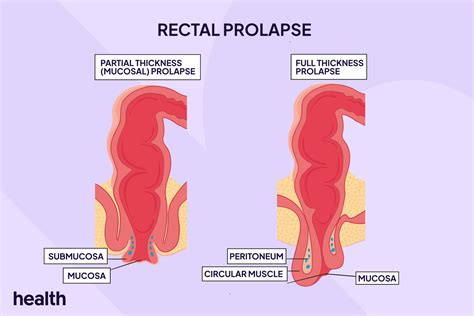 Rectal prolapse