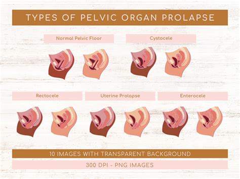 Rectocele What is it & treatments