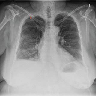 Recurrent Pneumothorax with CPAP Therapy for Obstructive ... - Hindawi