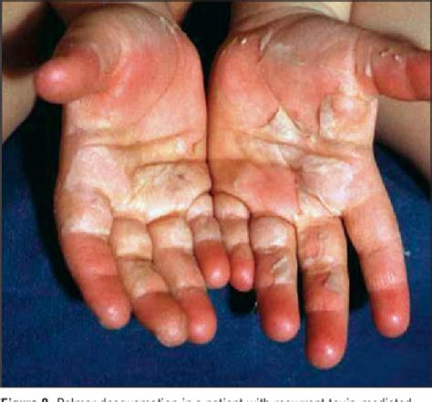 Recurrent toxin-mediated perineal erythema - Wikipedia