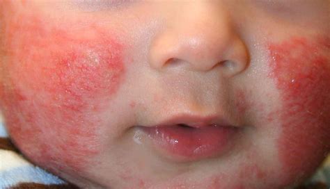 Red dry rash babys face. .  <a href=https://findlamp.ru/bfuo/lakeview-funeral-home-cemet...