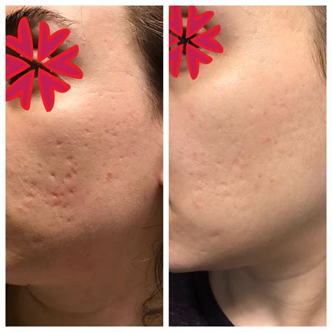Reddit bacne scars. Apr 11, 2024 ... To be honest, just like a chemical peel for the face for acne scars you can also get back acne scars. I was very scared and thought it was ... 