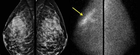 Reddit breast cancer. Explore global cancer data and insights. Lung cancer remains the most commonly diagnosed cancer and the leading cause of cancer death worldwide because of inadequate tobacco contro... 