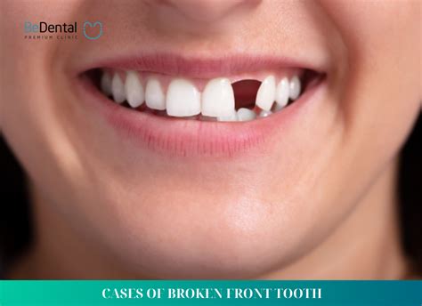 Reddit broken front teeth.  Aside other missing and broken ones, he is missing one of his fro...