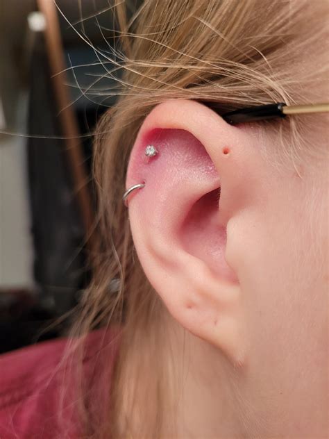 Reddit piercing. In my unprofessional opinion I would remove the piercing completely before the keloid/irritation bumps become permanent. Id still clean it as if it was a brand new piercing and then Id wait for the holes to completely close and the bumps to go down and then I would go to a different piercer and get it redone with a titanium bar. I hope this helped! 