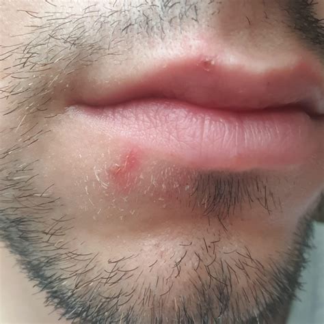 Redness after cold sore. .  <a href=https://litfa.manifestlao.com/asse...
