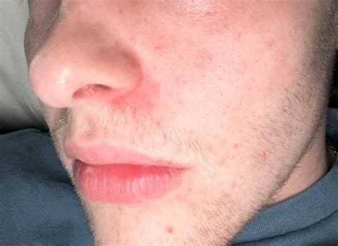 Redness around nose reddit.  I had this exact thing for about two years, could...