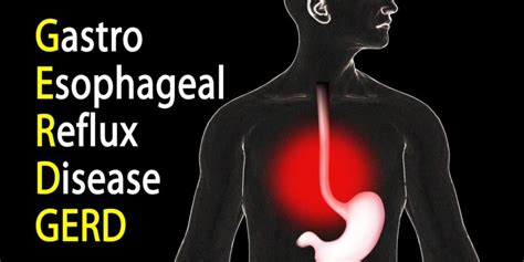 Reflux Diet - Monmouth Gastroenterology