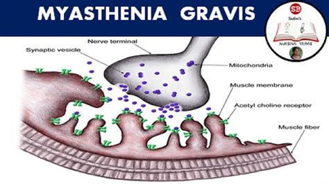 Refractory myasthenia gravis. INTRODUCTION Myasthenia gravis (MG) is an autoimmune neuromuscular disorder characterized by fluctuating motor weakness involving ocular, bulbar, limb, and/or respiratory muscles. 