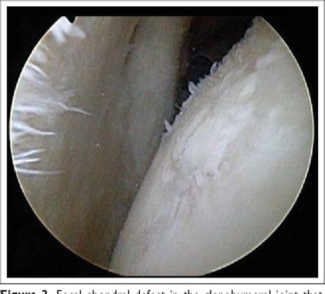 Rehabilitation After Glenohumeral Microfracture and …