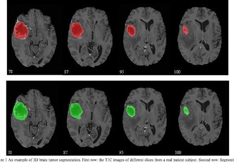 Relax and Focus on Brain Tumor Segmentation ScienceGate