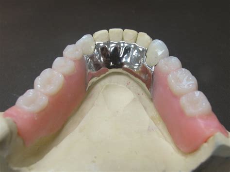 Removable partial dentures uses of guide planes. - Multiple chemical sensitivity a survival guide.