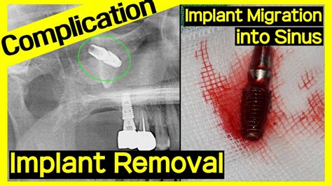 Removal of Root from Maxillary Sinus - YouTube