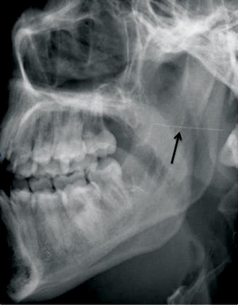 th?q=Removal of a fractured needle during inferior alveolar nerve block: two .