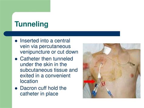 Removal of tunneled piccs IV-Therapy.net