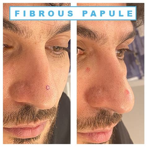 Remove fibrous papule of the nose at home. A fibrous papule of the nose is a common and harmless skin lesion. It is a firm solitary papule that occurs on or around the nose and has a characteristic 