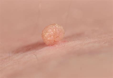 First and foremost, you should not diagnose a skin tag at home. It is always safe to get it diagnosed by a doctor in case the growth is cancerous. Toothpaste that contains hydrogen peroxide can dry the skin and cause wrinkles along with other damage. Apart from this, the removal of skin tags is a precarious process that can have complications.. 