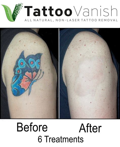 Remove tattoo near me. There are many different methods for removing an unwanted tattoo, including removal creams and laser tattoo removal, but when you want a method that gets the best results, no other option beats the Tattoo Vanish® Method.This one-of-a-kind tattoo removal process was developed by Mary Arnold-Ronish, a registered nurse with more than 30 years of … 