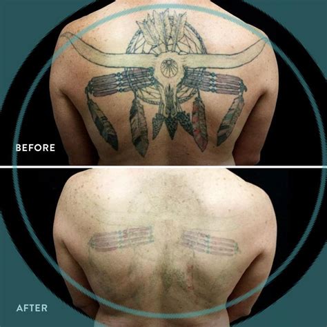 Removery tattoo. LaserAway offers laser tattoo removal services for all skin types and colors, with multiple sessions and options for full removal or cover up. Learn more about the process, the … 