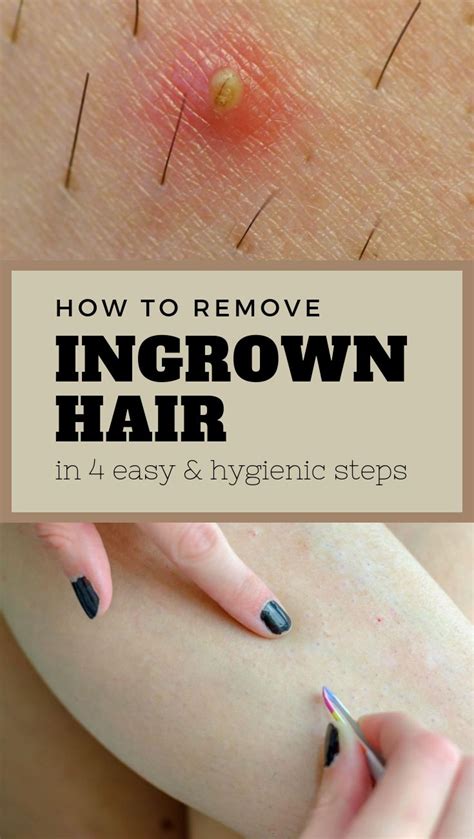 Removing ingrown hair videos. 4 days ago · Method 1. Extracting the Hair. Download Article. 1. Exfoliate the area to remove the skin covering the ingrown hair. Twice a day, scrub the ingrown hair gently using an over-the-counter exfoliator or an exfoliating glove. This will help to remove any dead skin cells, dirt, and oils that might be trapping the ingrown hair. 