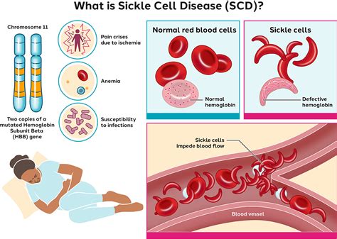 Renal abnormalities in sickle cell diseas…