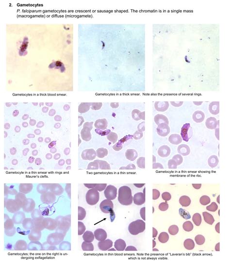 Renal detection of Plasmodium falciparum, Plasmodium vivax and ...