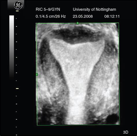 Rendered view of a normal uterus. Download Scientific Diagram