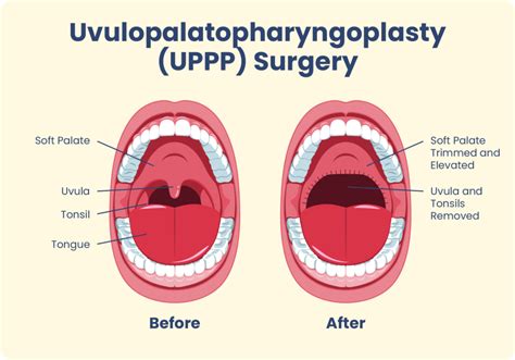 Reorganization of sleep patterns after UPPP in combination with …